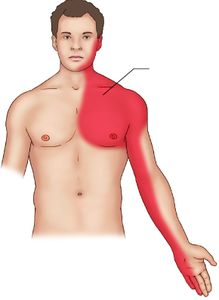 A mozgás a szívroham után is segít  - mozgás, egészség, szívroham, őssejtek, győri pszichiáter, pszichiáter Győr, depresszió, pánik, alvászavar, pszichológus